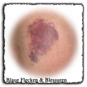 Blaue Flecken und Blessuren